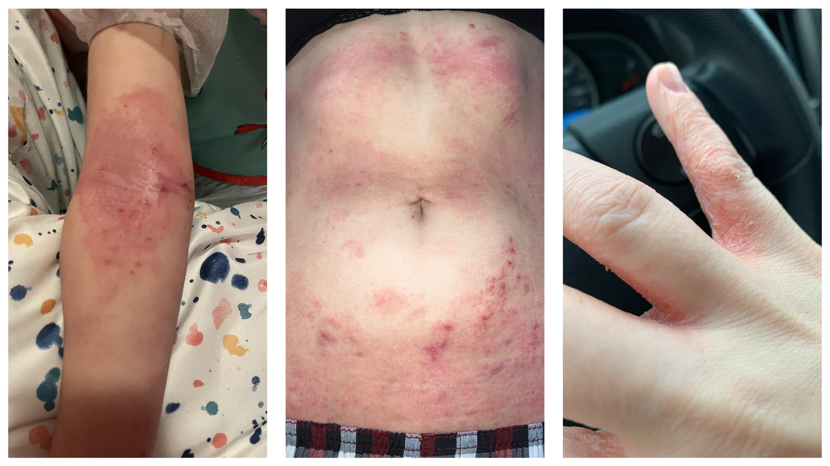 You’ve been applying ointment for years — and it keeps coming back.